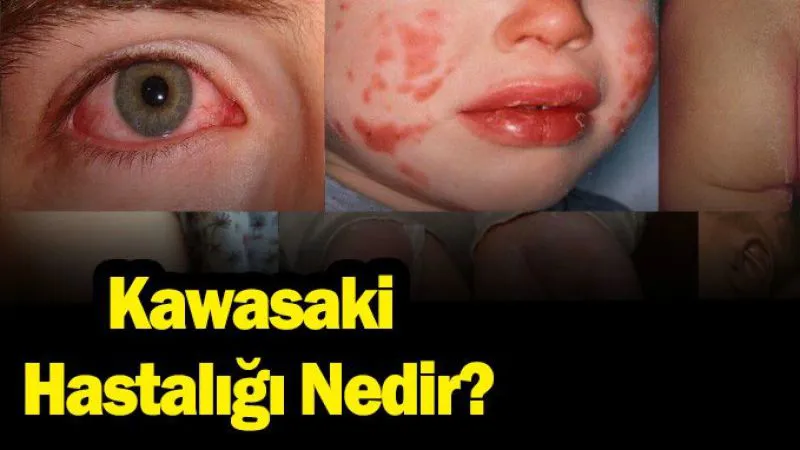 Kawasaki Hastalığı Nedir?