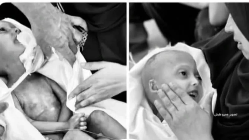 Gazze’de 4 Yaşındaki Hala Hanadi Açlık ve Tedavi Eksikliği Nedeniyle Yaşamını Yitirdi